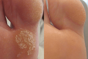 הסרת יבלות בכף הרגל