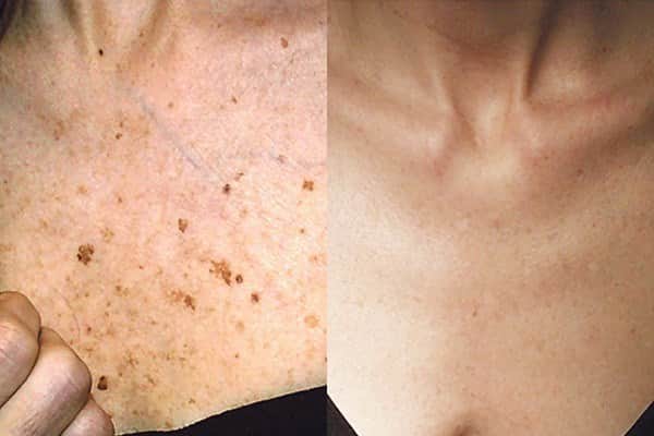 טיפול בפיגמנטציה באזור המחשוף