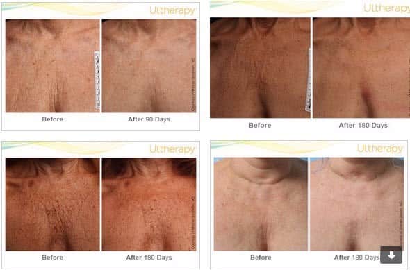 מתיחת אזור מחשוף/דקולטה