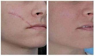 הסרת צלקות בלייזר בקריית ביאליק