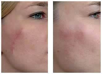 הסרת צלקות בלייזר