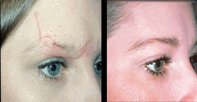 הסרת צלקות בלייזר