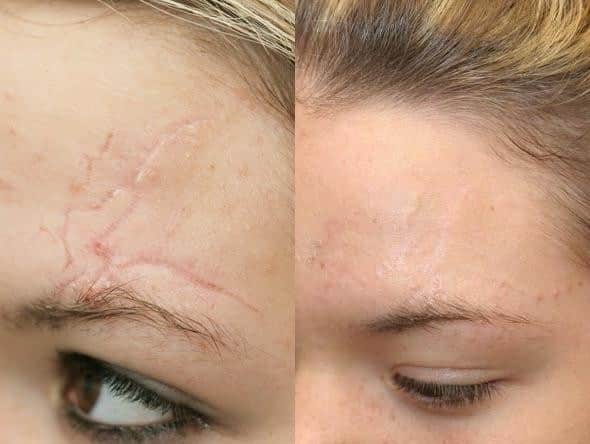 הסרת צלקות בלייזר