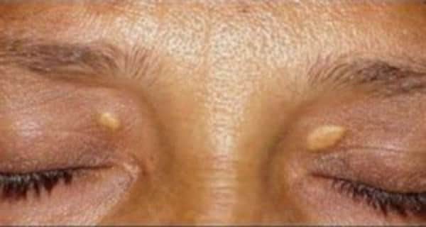 טיפול הסרת קסנטלזמה בלייזר