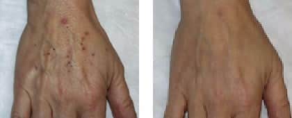 הצערת עור הידיים בלייזר