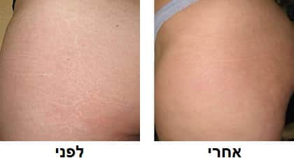 העלמת סימני מתיחה | טיפול הסרת סימני מתיחה בלייזר
