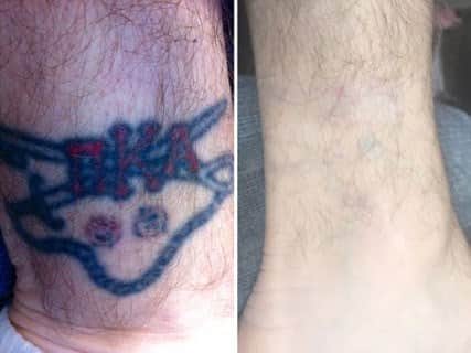 הסרת קעקועים בלייזר לפני ואחרי