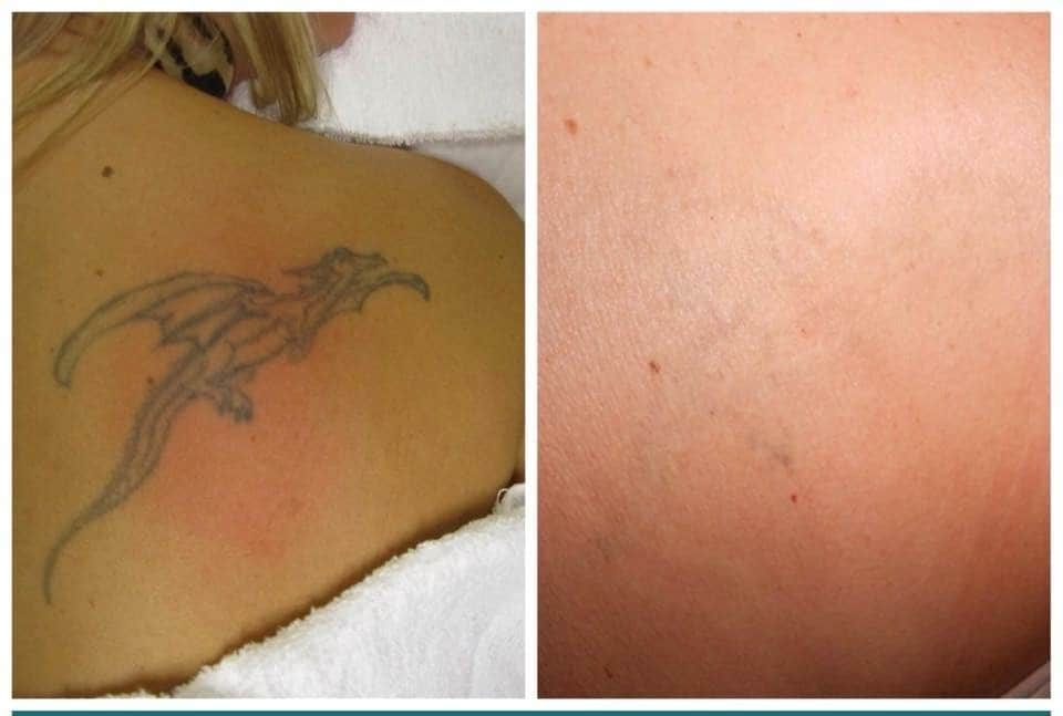 הסרת קעקועים בלייזר לפני ואחרי