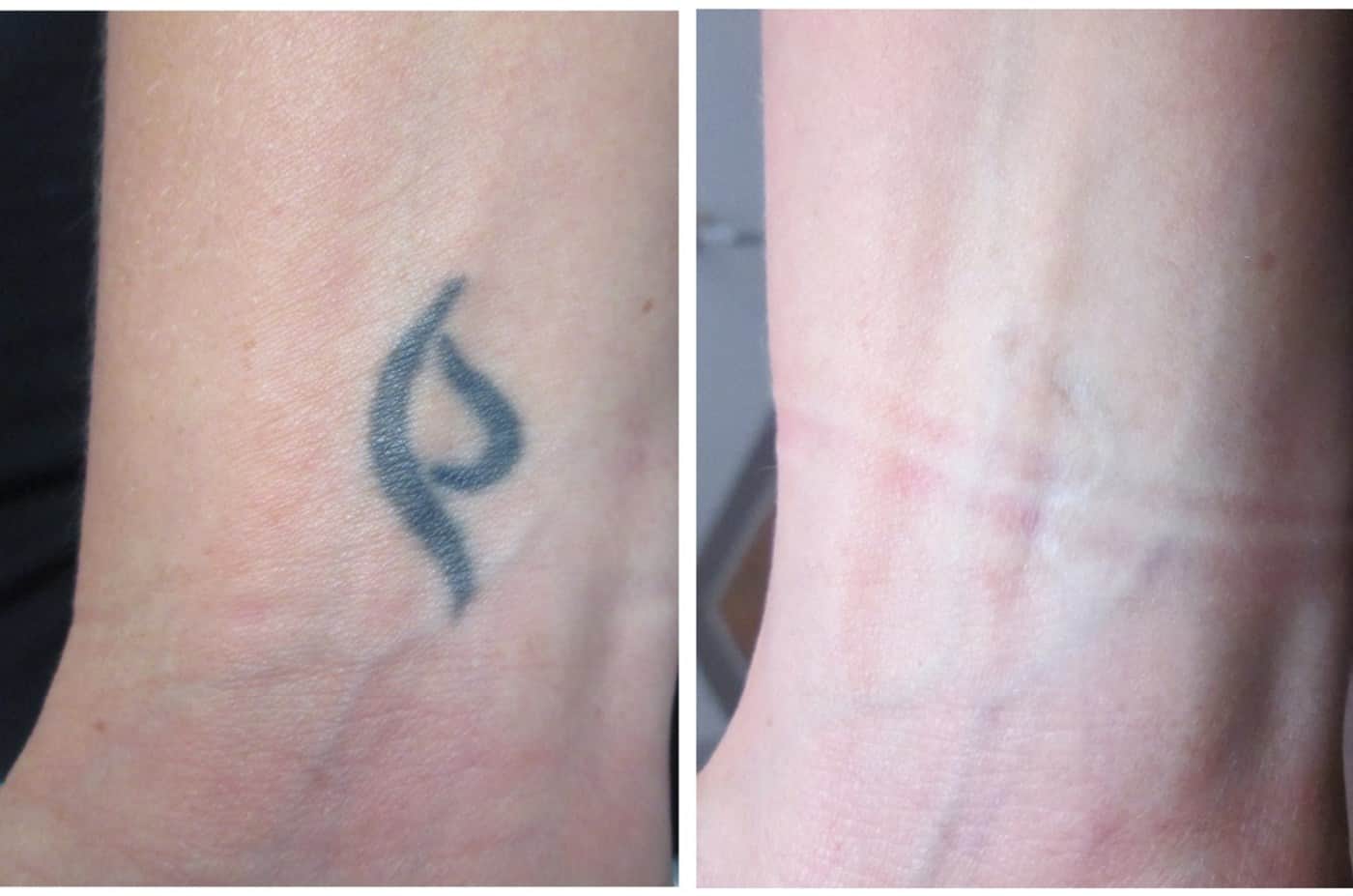 הסרת קעקועים בלייזר לפני ואחרי