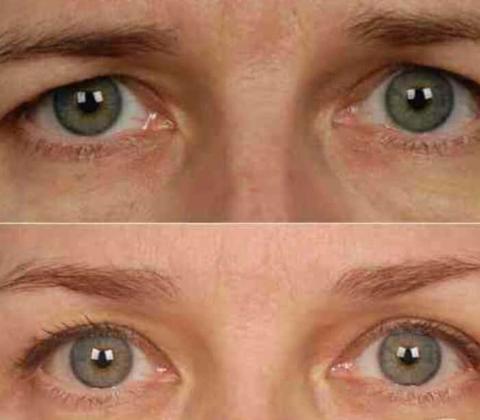 הרמת עפעפיים בלייזר