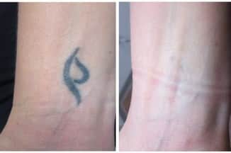 הסרת קעקועים בלייזר לפני ואחרי