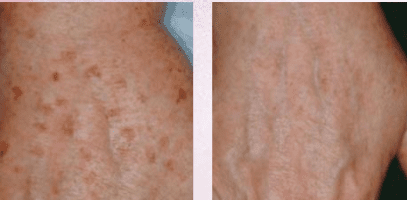 טיפול בפיגמנטציה בידיים