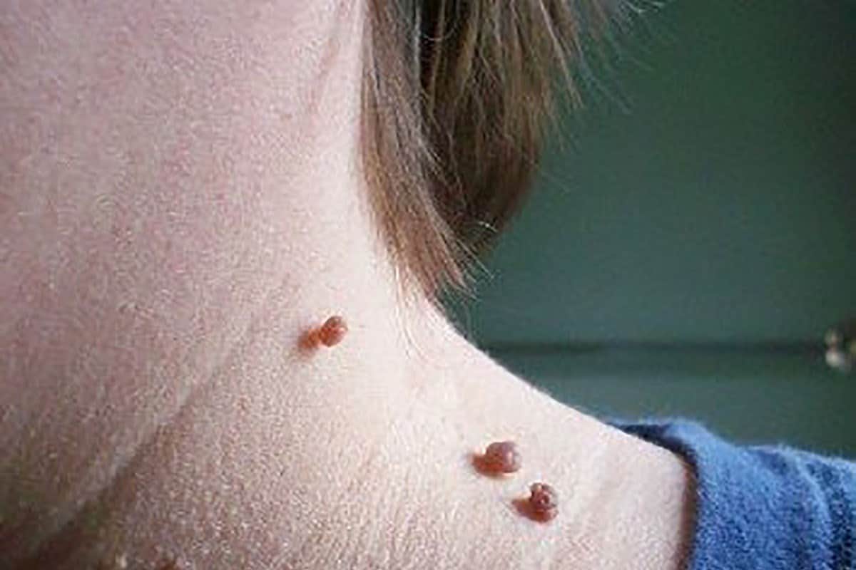 הסרת סרחי עור