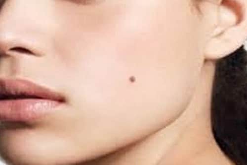 הסרת נקודות חן