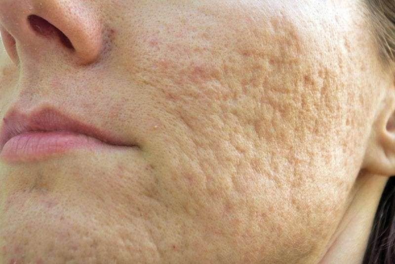 הסרת צלקות בלייזר