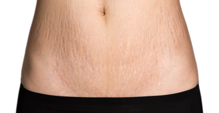 העלמת סימני מתיחה