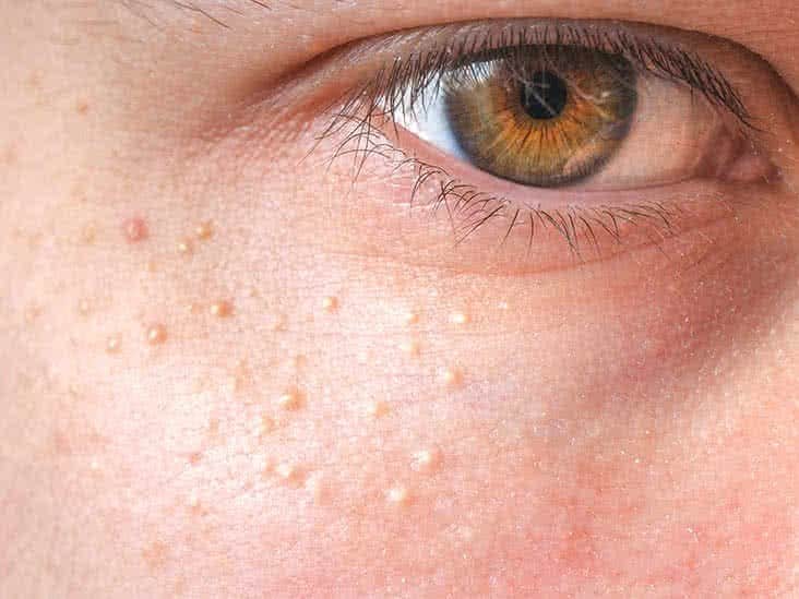 הסרת גושי שומן / מילה בלייזר