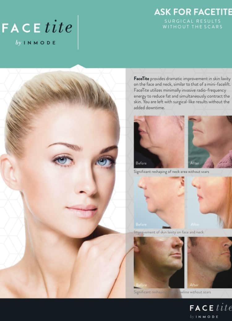 טיפול בסנטר כפול - פייסטייט