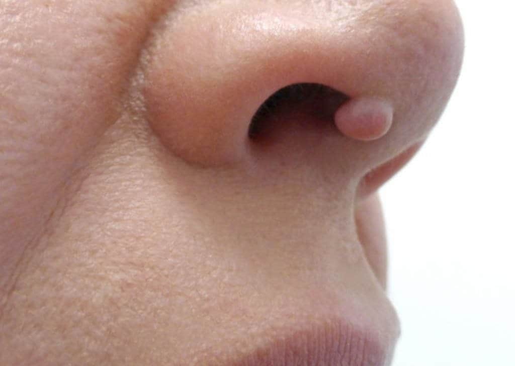 הסרת סרחי עור באף