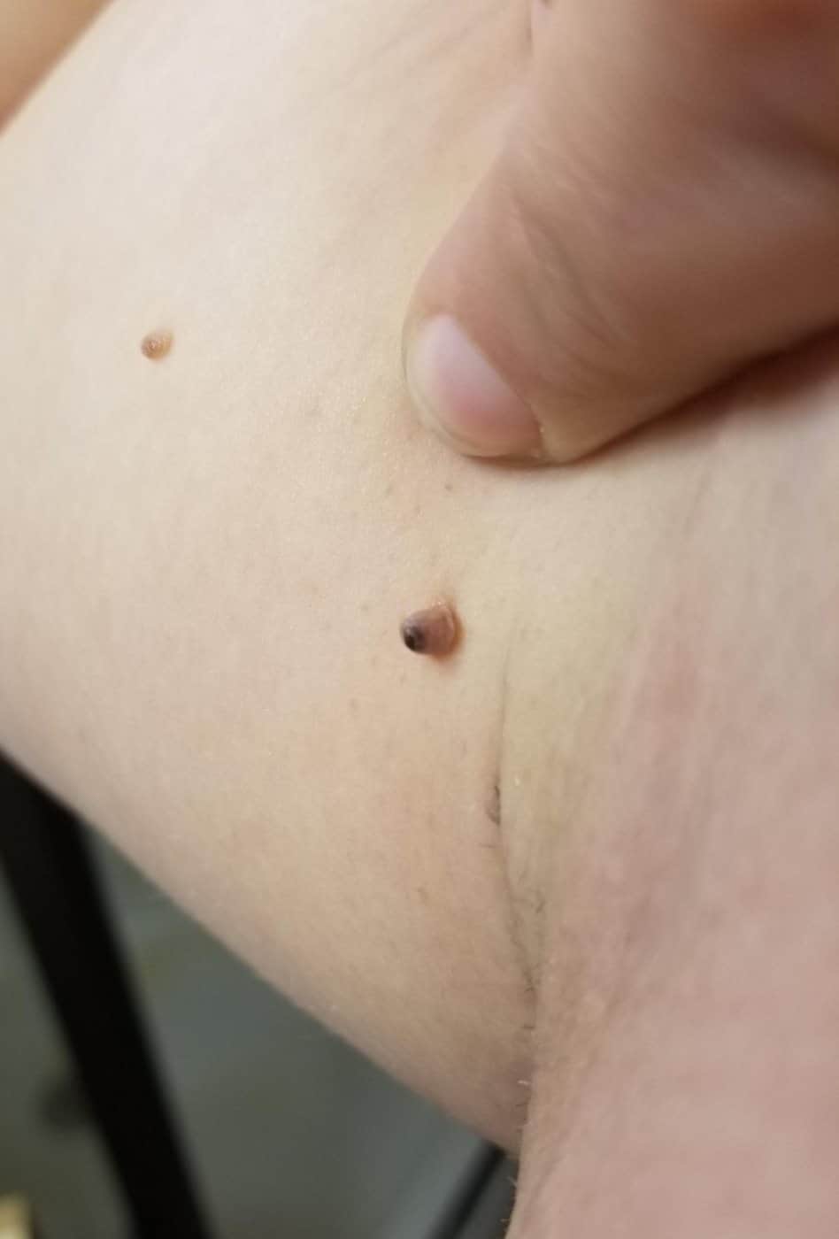 הסרת סרחי עור בבית שחי