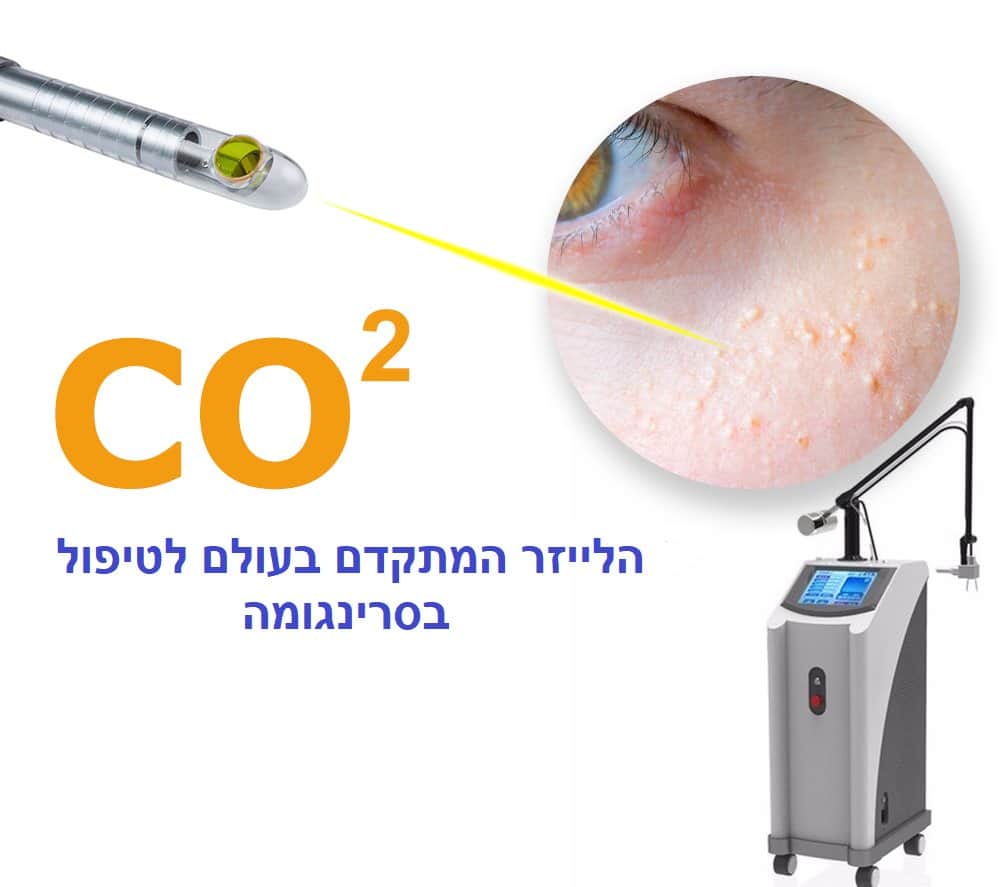 הסרת סרינגומה בלייזר