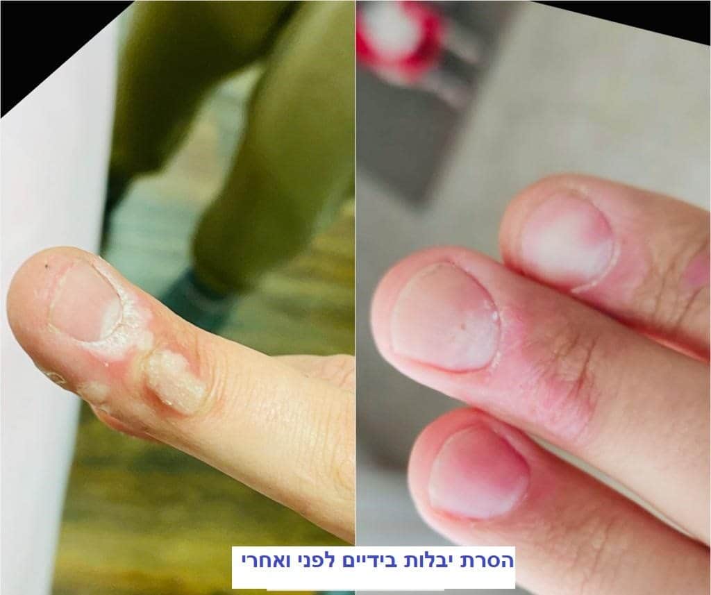הסרת יבלות בידיים - לפני ואחרי
