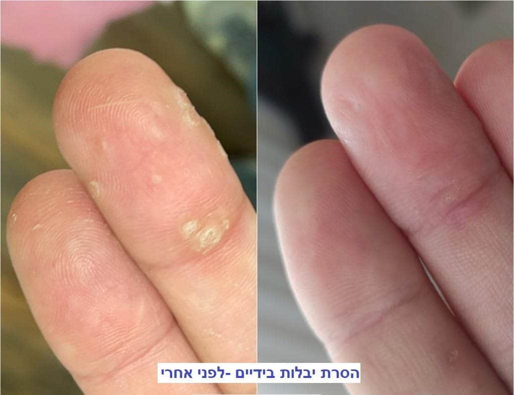 הסרת יבלות בידיים - לפני ואחרי