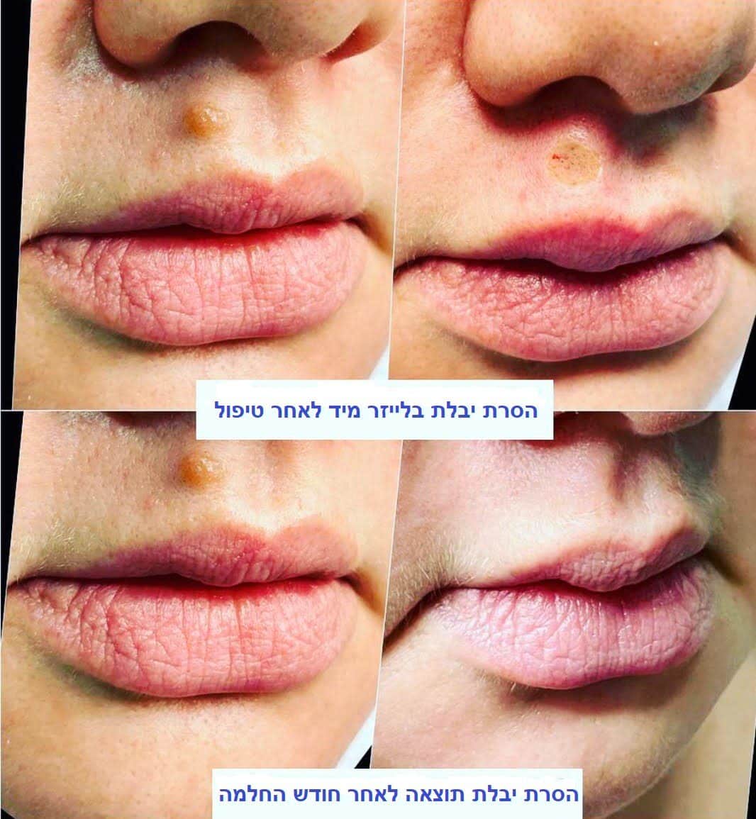 הסרת יבלות בפניפ - לפני ואחרי