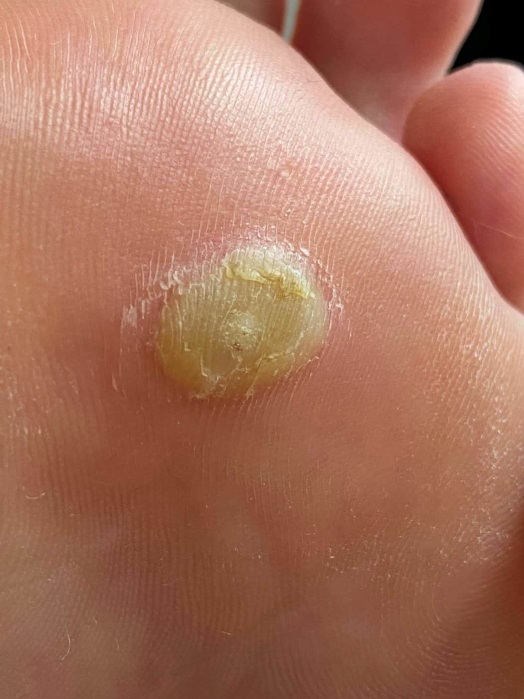 יבלת קורן בכף הרגל