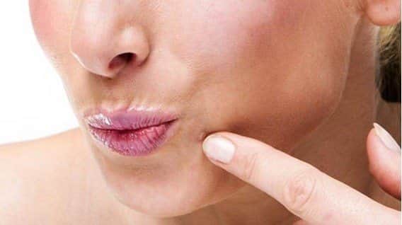 הסרת יבלות ויראליות בפנים