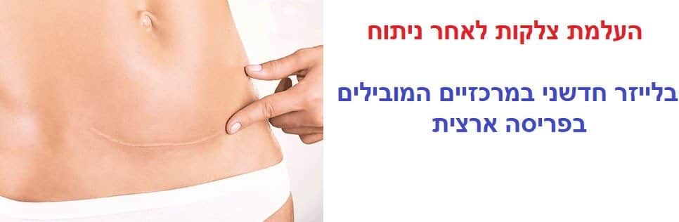 העלמת צלקות לאחר ניתוח