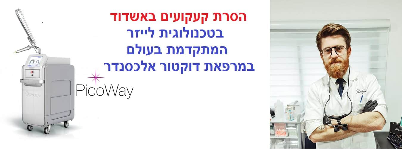 הסרת קעקועים בלייזר באשדוד