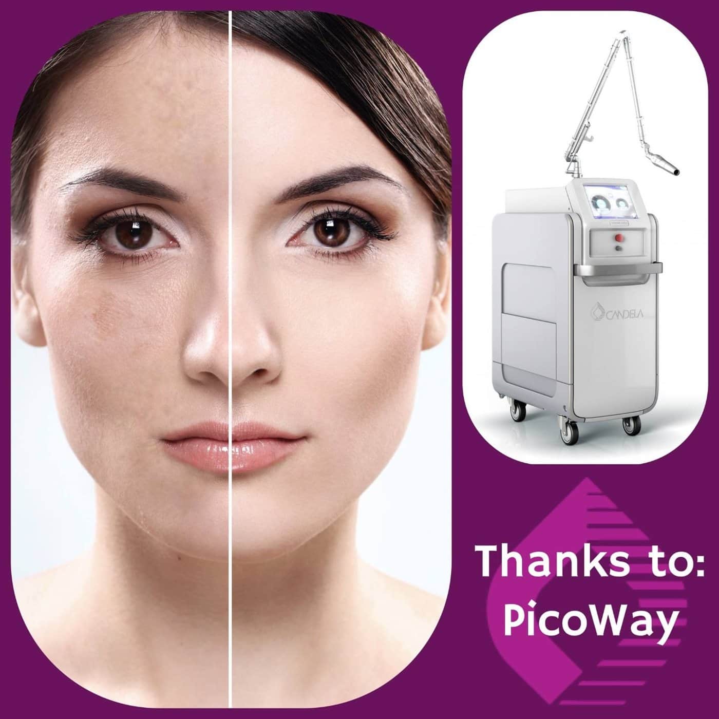 טיפול בפיגמנטציה בלייזר באשדוד