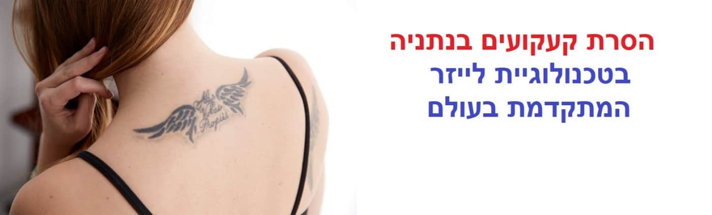 הסרת קעקועים בנתניה