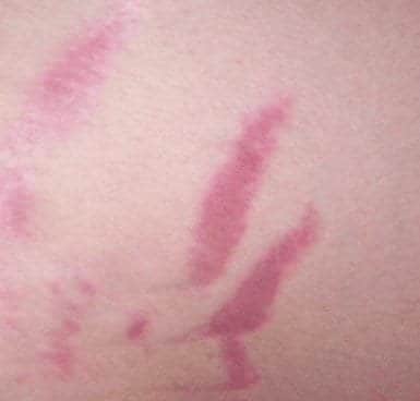 העלמת סימני מתיחה אדומים