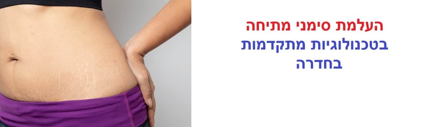 העלמת סימני מתיחה בחדרה