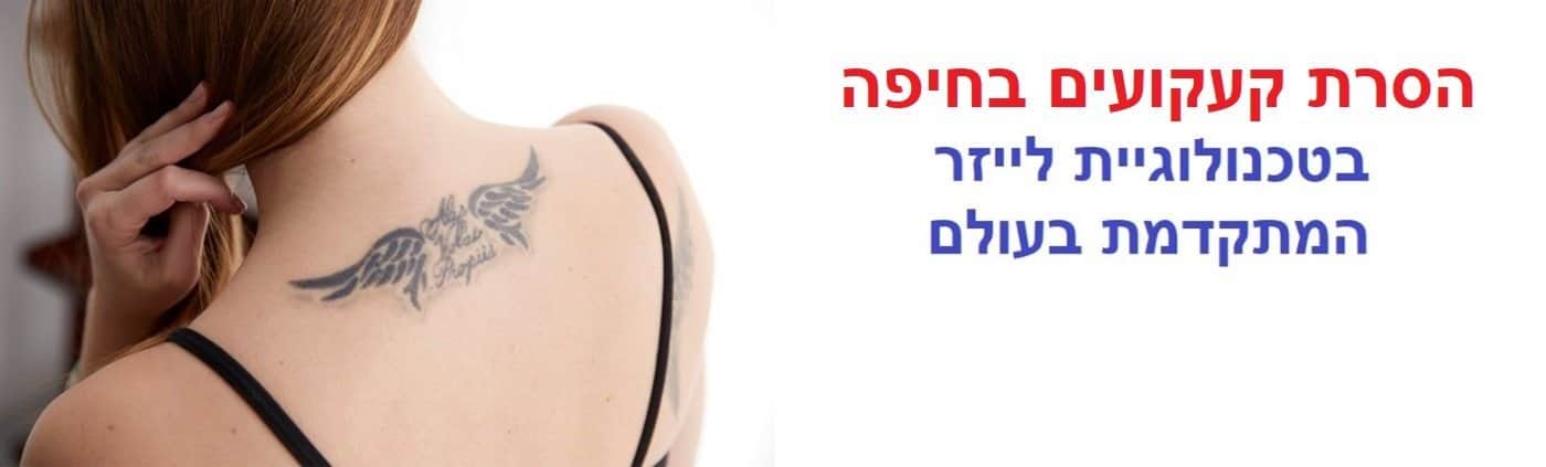 הסרת קעקועים בלייזר בחיפה