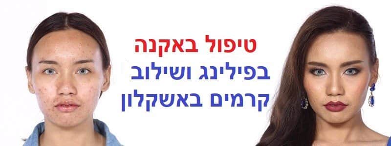 טיפול אקנה בפלזמה באשקלון | הסרת אקנה בפלזמה באשקלון
