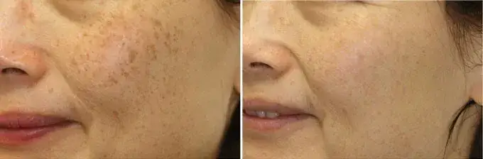 טיפול בפיגמנטציה