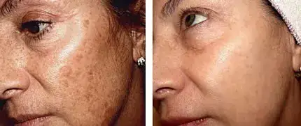 טיפול בפיגמנטציה