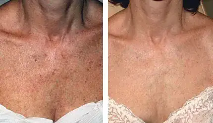 טיפול בפיגמנטציה