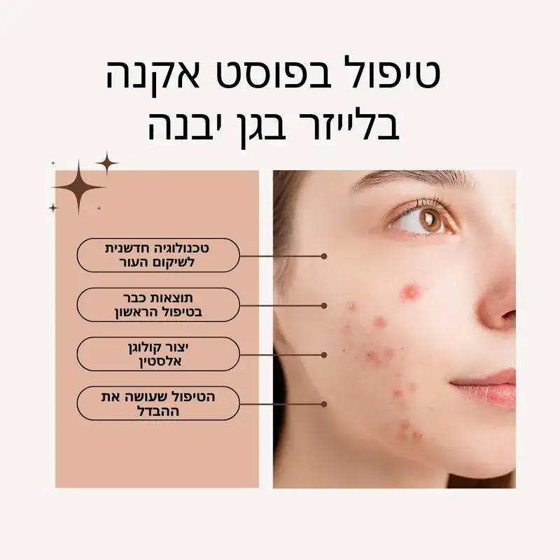 טיפול פוסט אקנה בגן יבנה