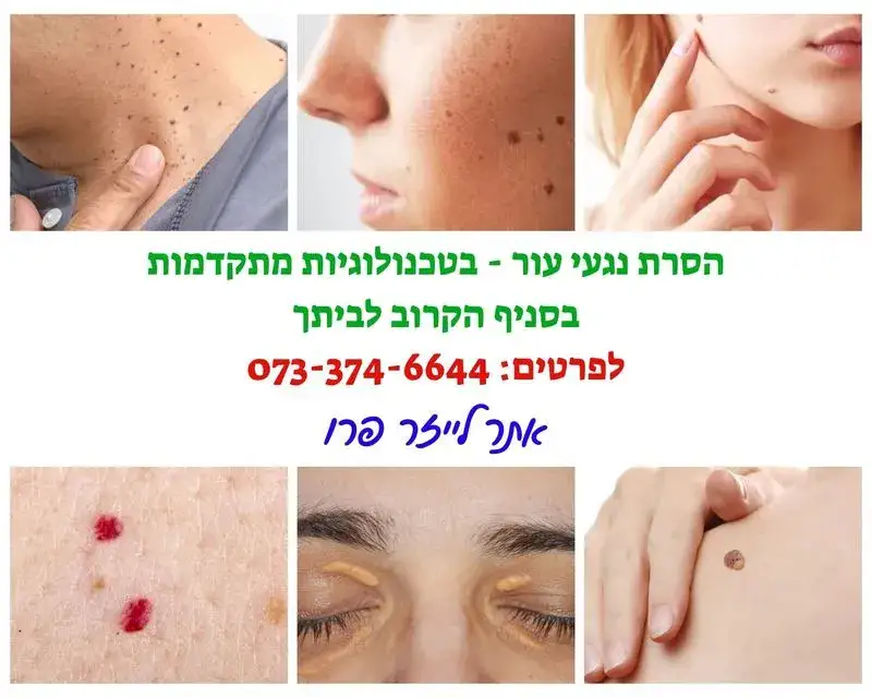 הסרת נגעי עור בגן יבנה