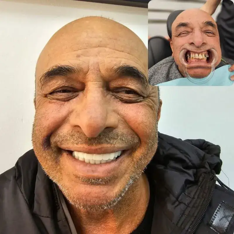 טיפולי שיניים בגאורגיה - לפני אחרי