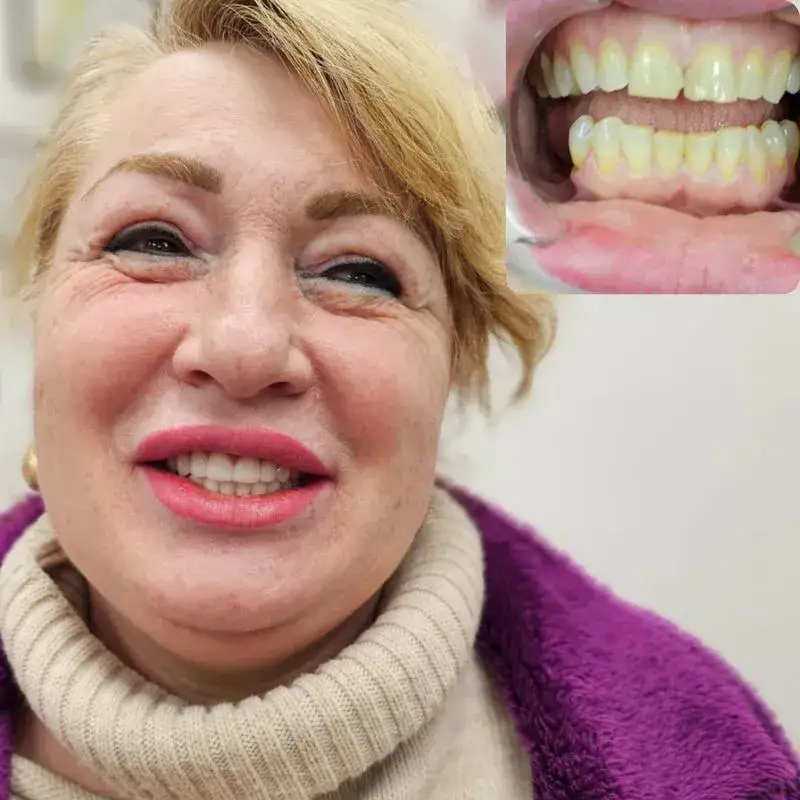 טיפולי שיניים בגאורגיה - לפני אחרי