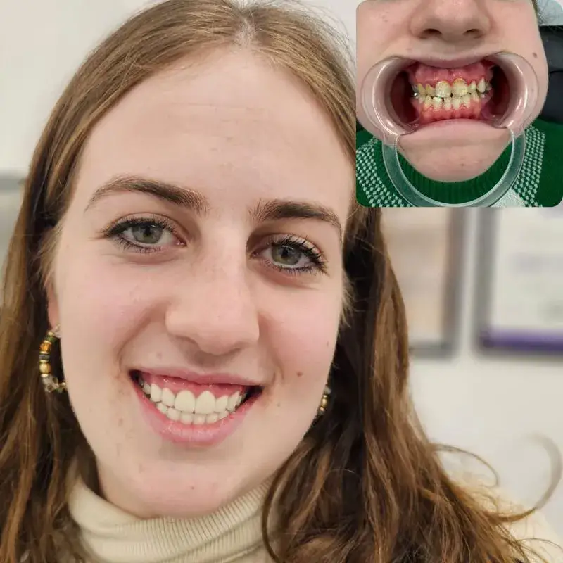 טיפולי שיניים בגאורגיה - לפני אחרי