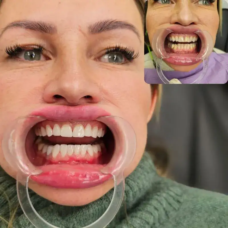 טיפולי שיניים בגאורגיה - לפני אחרי