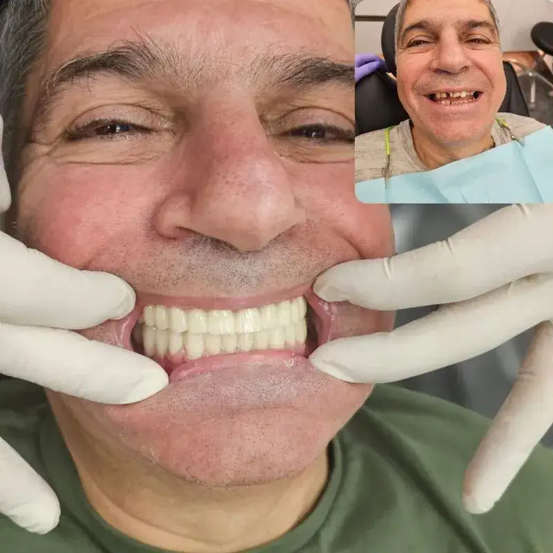 טיפולי שיניים בגאורגיה - לפני אחרי
