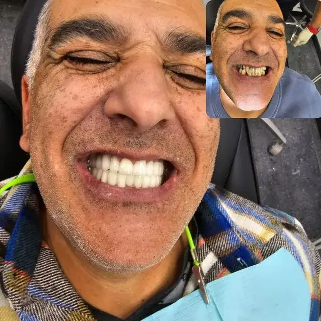 טיפולי שיניים בגאורגיה - לפני אחרי