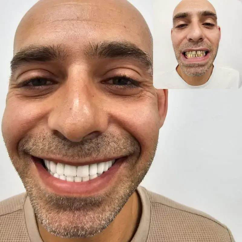 טיפולי שיניים בגאורגיה - לפני אחרי